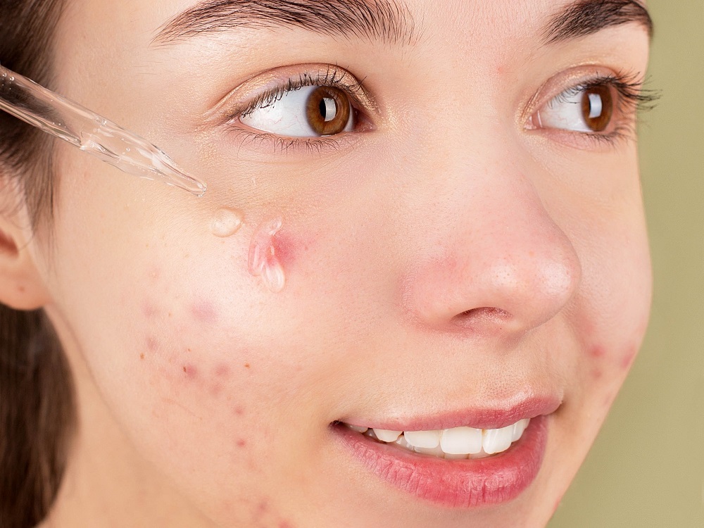 Cara Menggunakan Skincare untuk Kulit Berjerawat 