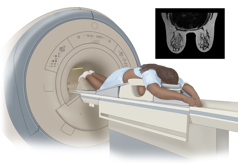 MRI (Magnetic Resonance Imaging) Payudara