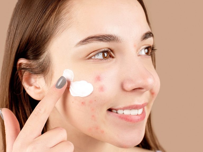 Tips Memilih Skincare untuk Kulit Berjerawat yang Tepat dan Aman
